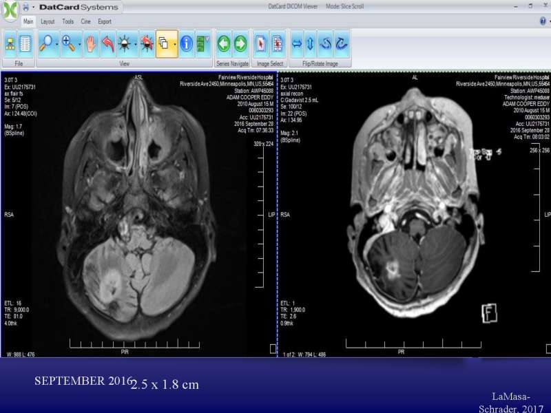 Emotional roots in Brain Cancers page 36